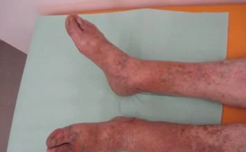 Tromboflebita - recomandări și remedii naturiste pentru tratament