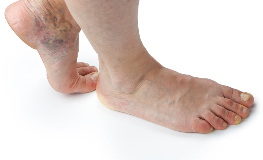 simptome tromboflebita picior