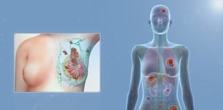 Factori de risc pentru declanșarea cancerului de sân influențați de alimentație Factori de risc pentru declanșarea cancerului de sân influențați de alimentație