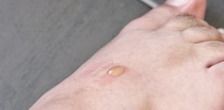 Măsuri de prim ajutor în caz de bășici la picioare