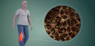 Osteoporoza și cauzele pierderii densității osoase