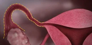 Cancerul trompei uterine – Care sunt simptomele și metodele de tratament