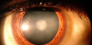 În ce constă operația de cataractă și câte feluri de cristaline artificiale se folosesc pentru operație În ce constă operația de ca
