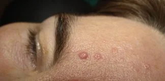 Tu știi ce este keratoza seboreică Este posibil să ai și tu astfel de leziuni necanceroase pe piele