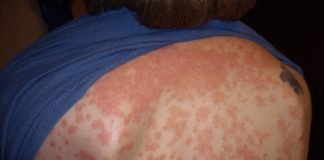 Descoperă cauzele care determină apariția psoriazisului și modalitățile de prevenire ale afecțiunii Descoperă cauzele care determină apariția psoriazisului și modalitățile de prevenire ale afecțiunii