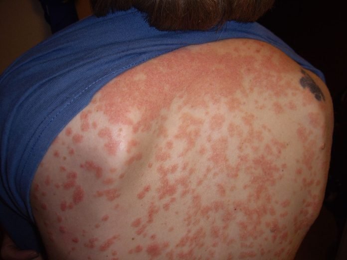 Descoperă cauzele care determină apariția psoriazisului și modalitățile de prevenire ale afecțiunii Descoperă cauzele care determină apariția psoriazisului și modalitățile de prevenire ale afecțiunii