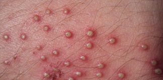 Foliculita, infecția rădăcinii firului de păr – Află care sunt factorii favorizanți dezvoltarii bolii și tratamentul recomandat Foliculita, infecția rădăcinii firului de păr – Află care sunt factorii favorizanți dezvoltarii bolii și tratamentul recomandat