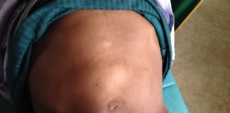 Hepatomegalia reprezintă umflarea exagerată a ficatului, acesta are volumul atât de mult mărit încât depășește zona coastelor pe linia medio-claviculară.