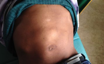 Hepatomegalia reprezintă umflarea exagerată a ficatului, acesta are volumul atât de mult mărit încât depășește zona coastelor pe linia medio-claviculară.