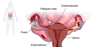 Zone reflexogene pentru tratamentul endometriozei Zone reflexogene pentru tratamentul endometriozei