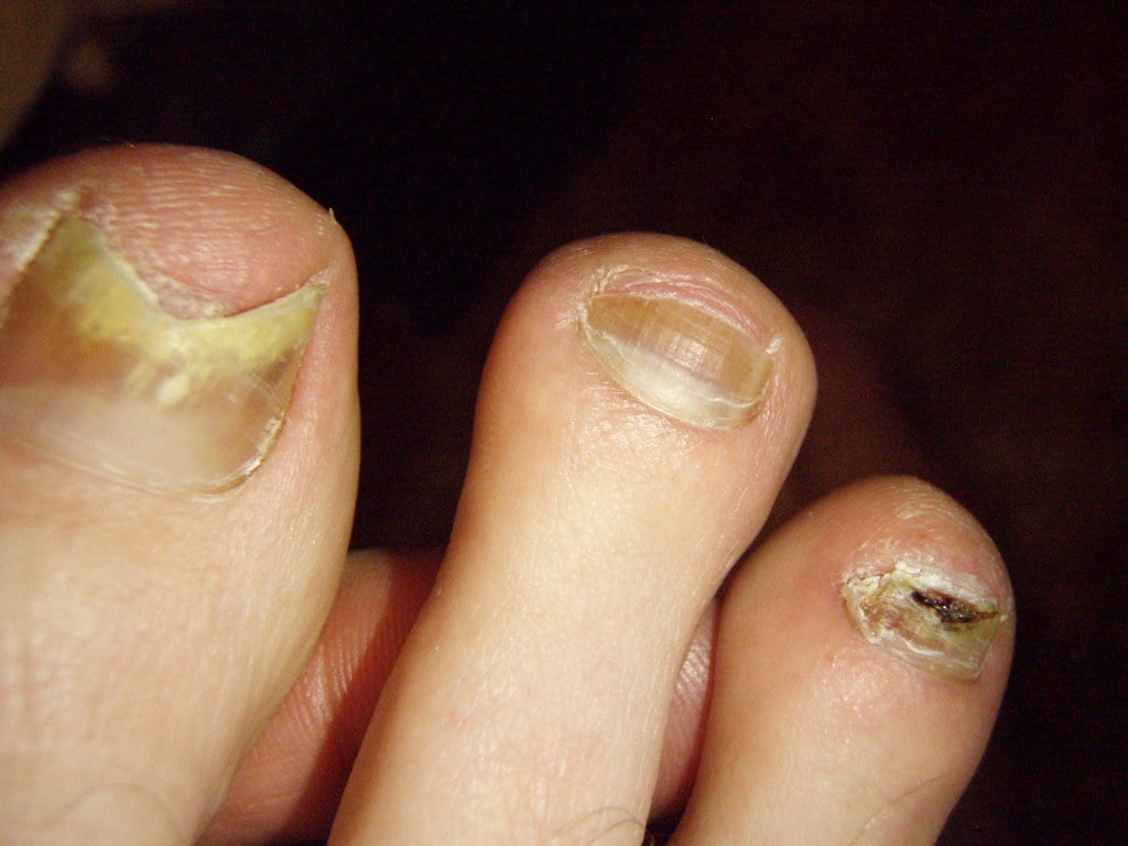 afectiuni ale unghiilor