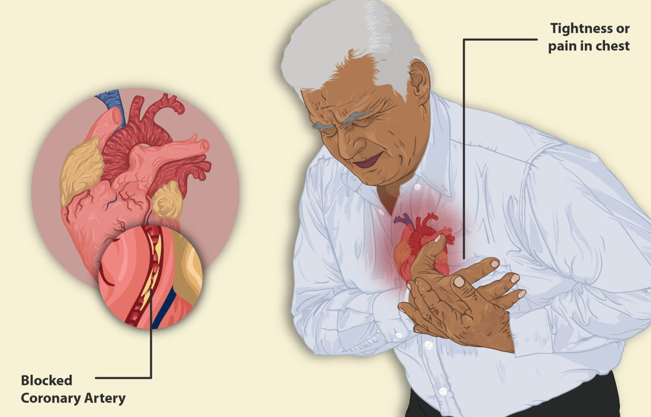 Angina pectorală – cum prevenim durerea în piept care apare la efort sau la emoții