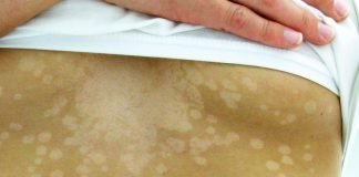 Cauzele manifestării pitiriazisului versicolor – infecția fungică ce apare frecvent pe piept și spate Cauzele manifestării pitiriazisului versicolor – infecția fungică ce apare frecvent pe piept și spate