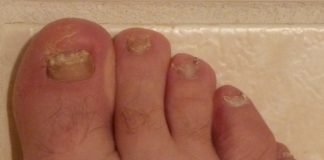 Cum se manifestă onicomicoza (infecția fungică a unghiei) și care sunt cele mai sigure metode de tratament? Cum se manifestă onicomicoza (infecția fungică a unghiei) și care sunt cele mai sigure metode de tratament