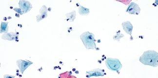 Durerea la urinare și infecția genitală cu Trichomonas vaginalis, vaginita trichomoniazică – cauze, simptome și tratament Durerea la urinare și infecția genitală cu Trichomonas vaginalis, vaginita trichomoniazică – cauze, simptome și tratament