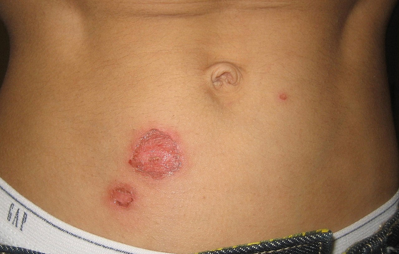 Impetigo la nivelul abdomenului
