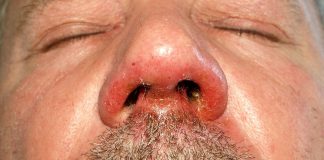 Simptomele și diagnosticul infecției contagioase a stratului superficial al epidermului: Impetigo sau piodermita superficială Simptomele și diagnosticul infecției contagioase a stratului superficial al epidermului Impetigo sau piodermita superficială
