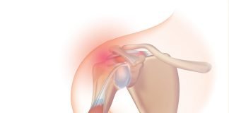 Sindromul coafei rotatorilor – Care sunt simptomele și cum tratăm inflamația? Sindromul coafei rotatorilor – Care sunt simptomele și cum tratăm inflamația