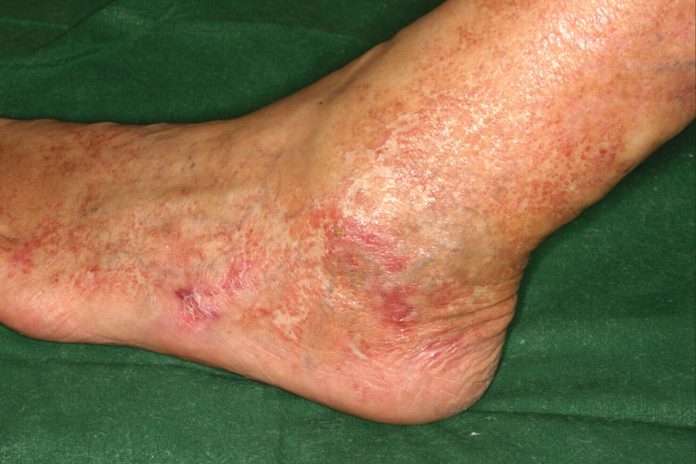 Cum să tratezi rănile piciorului diabetic Amputarea piciorului varicos