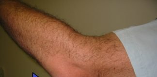 Bursita, inflamație a bursei – Iată care sunt principalele cauze și simptome resimțite de către pacienți Bursita, inflamație a bursei – Iată care sunt principalele cauze și simptome resimțite de către pacienți