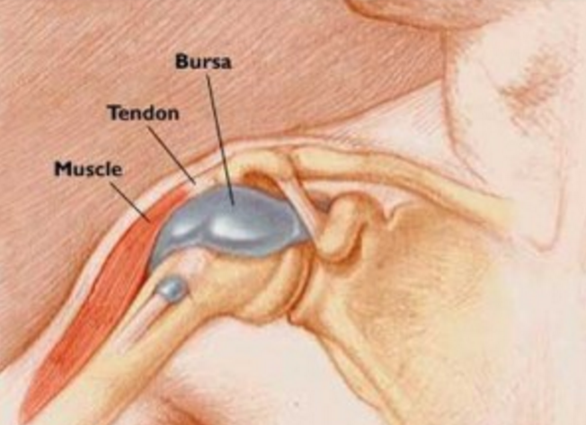Препателярный бурсит. Воспаление Бурсы синовиальной плеча.