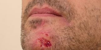 Măsuri de prim ajutor în caz de leziune facială – Cum reacționezi corect în caz de traumatism la nivelul feței? Măsuri de prim ajutor în caz de leziune facială – Cum reacționezi corect în caz de traumatism la nivelul feței