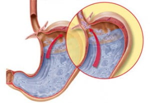 Boală de reflux gastro-esofagian, Foto: laparoscopyindia.com