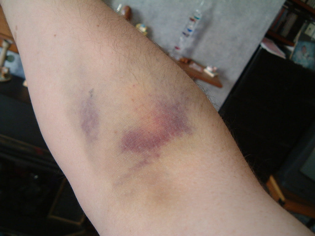 vanatai, contuzii, leziuni