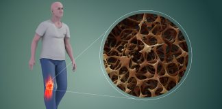 Fracturi apărute datorită unor condiții medicale care slăbesc oasele – Osteoporoza și alte boli ale oaselor Fracturi apărute datorită unor condiții medicale care slăbesc oasele – Osteoporoza și alte boli ale oaselor
