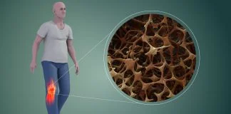 Fracturi apărute datorită unor condiții medicale care slăbesc oasele – Osteoporoza și alte boli ale oaselor