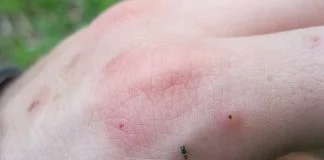 Mușcături de păianjen și înțepături de scorpion - Metode de tratament