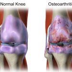 Osteoartrita boala degenerativă a articulațiilor – Modalități de ameliorare și prevenire a osteoartritei