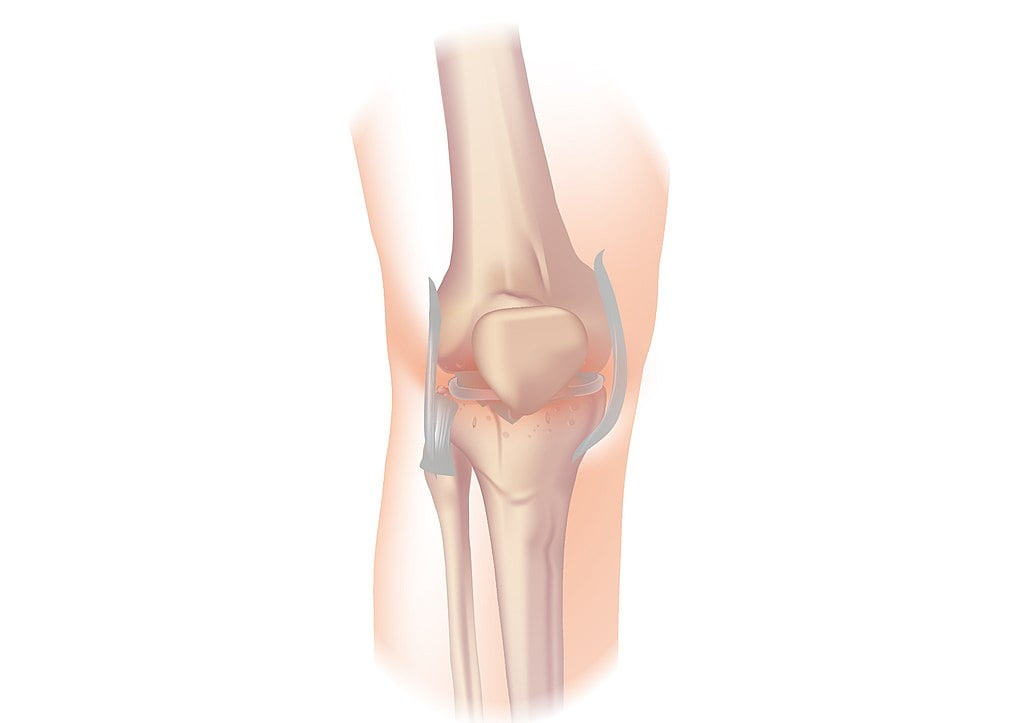 Osteoartrita