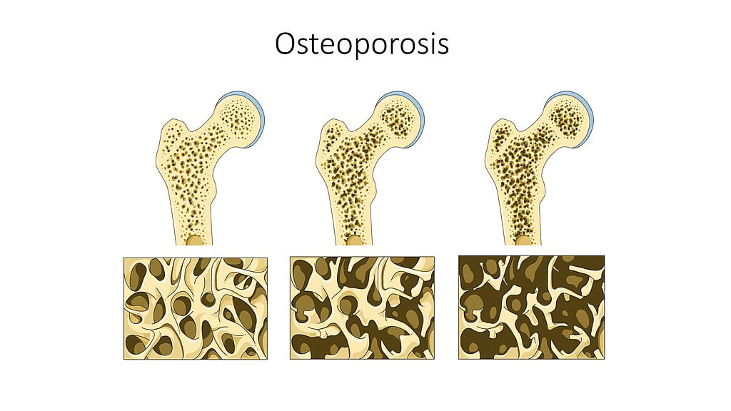 osteoporoza