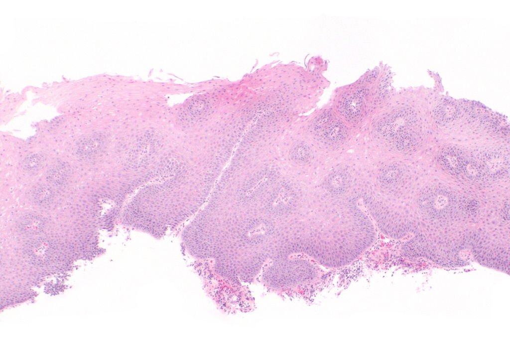 reflux gastro-esofagianreflux gastro-esofagian