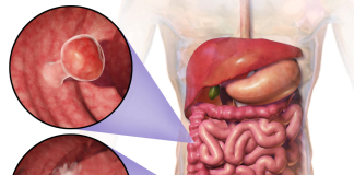 Care este vârsta la care apare cancerul colorectal și cum poate fi acesta prevenit