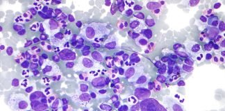 Formele de cancer ale sistemului limfatic – Ce trebuie să știți despre Limfomul Hodgkin și Non-Hodgkin