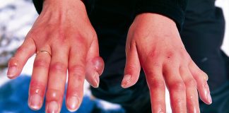 Măsuri de prim ajutor în caz de degerături Măsuri de prim ajutor în caz de degerături