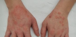 Medicamente și boli care pot cauza erupții sau urticarie pe piele – Cum le deosebești