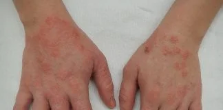 Medicamente și boli care pot cauza erupții sau urticarie pe piele – Cum le deosebești