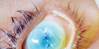 Xeroftalmia – Inflamația corneei Xeroftalmia - Inflamația corneei