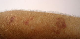 Care sunt afecțiunile cutanate proprii vârstei a treia Află ce tip de dermatoze senile există