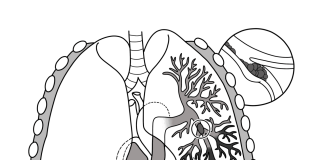 Descoperă cât de grav este embolismul pulmonar – blocajul total sau parțial al arterei pulmonare