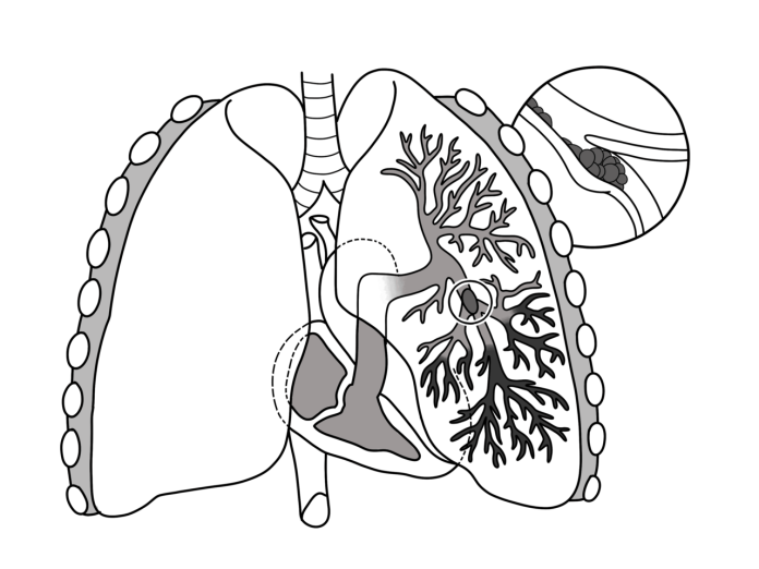 Descoperă cât de grav este embolismul pulmonar – blocajul total sau parțial al arterei pulmonare Descoperă cât de grav este embolismul pulmonar – blocajul total sau parțial al arterei pulmonare