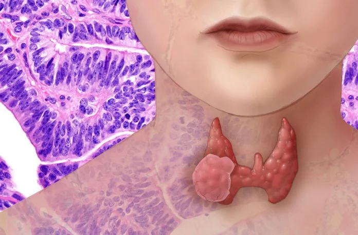 Tratarea cancerului tiroidian are o rată de succes ce se apropie de 100% Tratarea cancerului tiroidian are o rată de succes ce se apropie de 100%