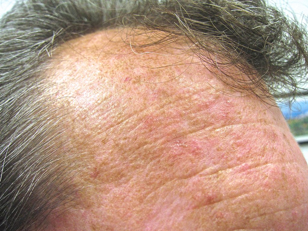 alopecia senila