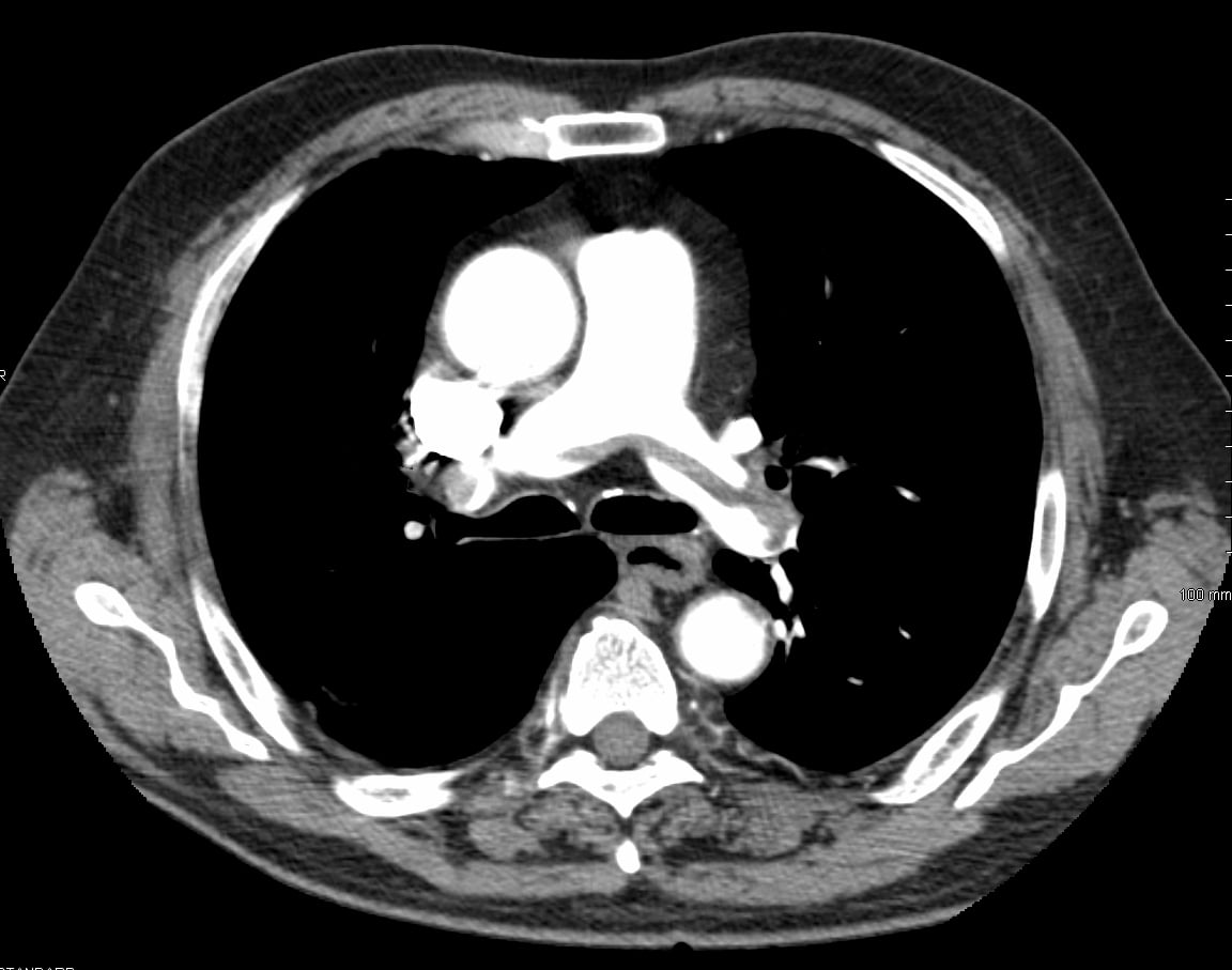 embolism pulmonar