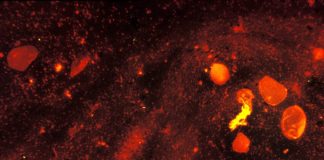 Cum se transmite infecția cu tuberculoză și care sunt metodele de tratament