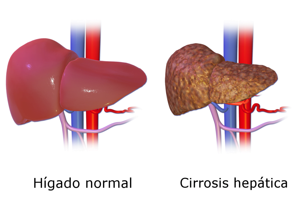 ciroza hepatica