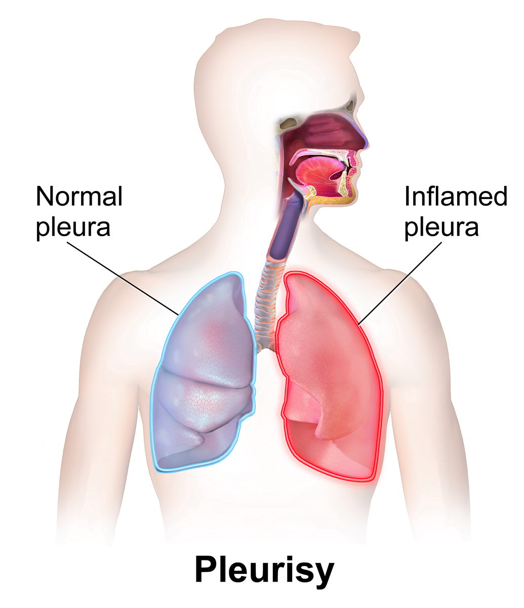 pleurezia